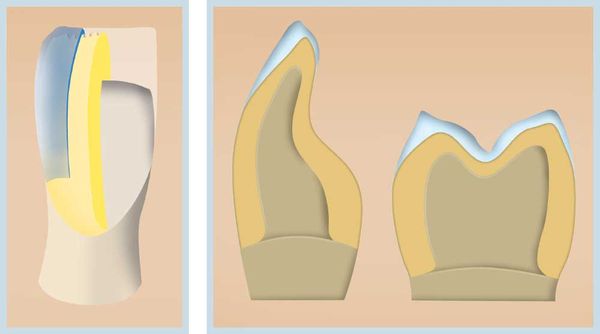 IPS e.max System Darstellung Cut-Back-Technik