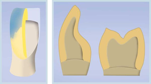IPS e.max System Maltechnik Darstellung